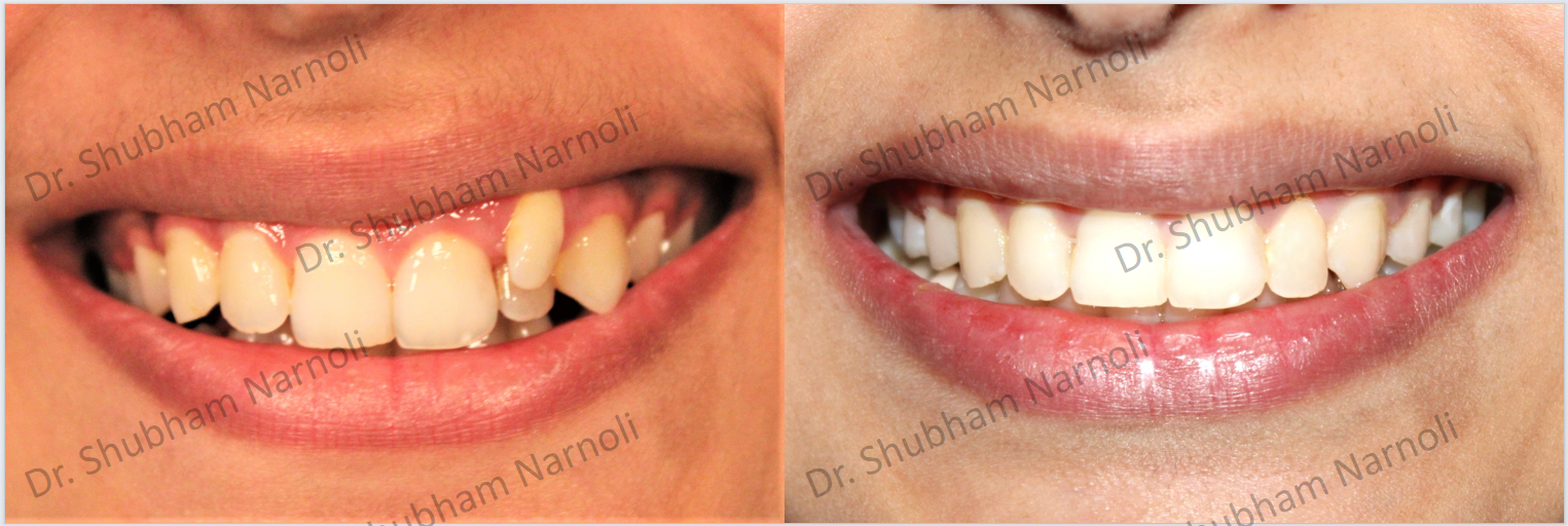 Before and after dental transformation 1