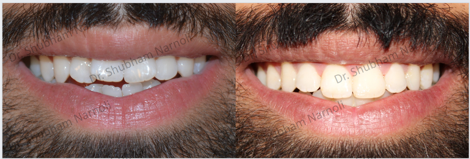 Before and after dental transformation 3