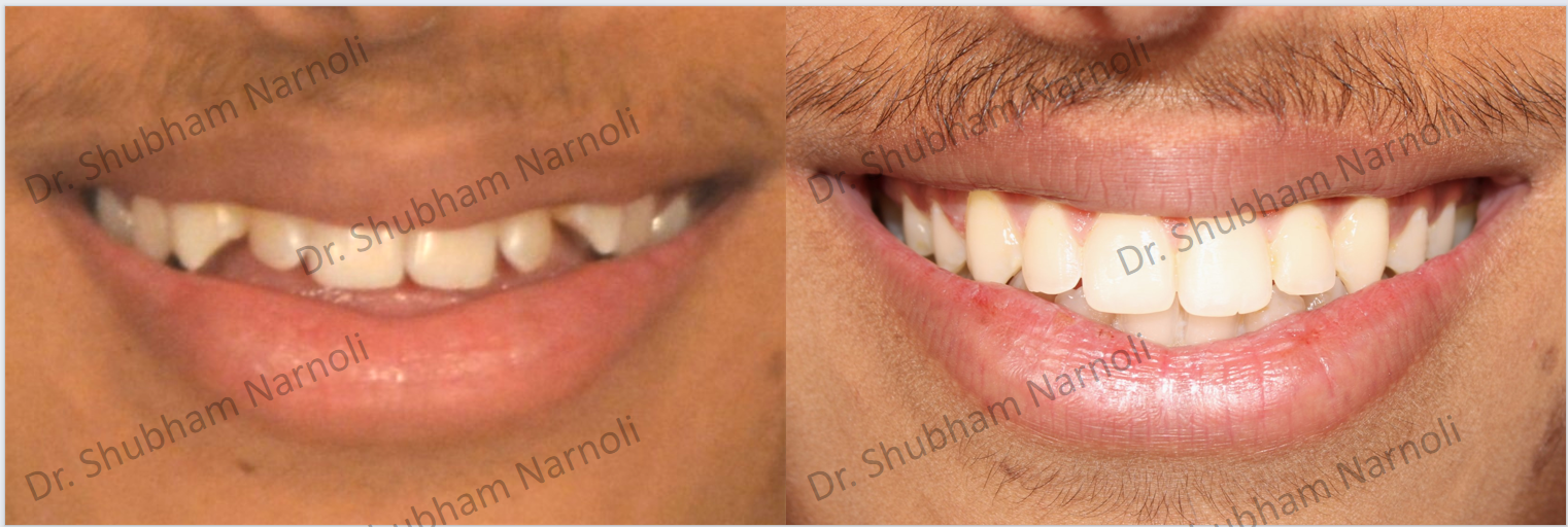 Before and after dental transformation 5