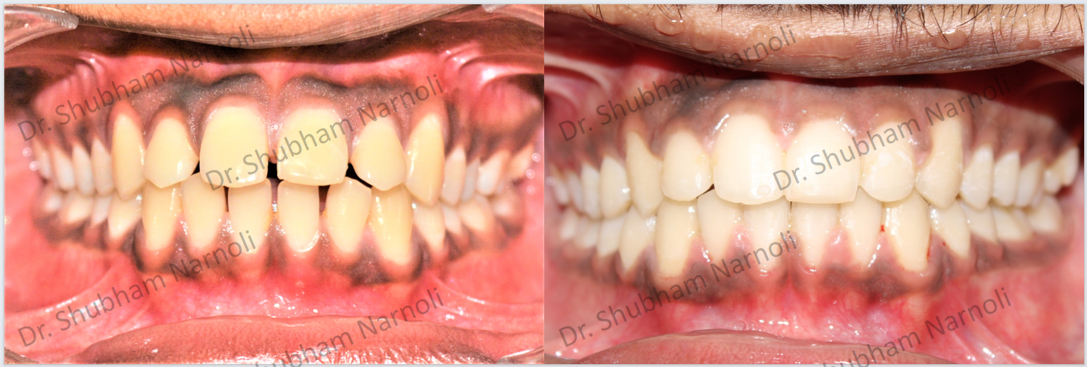 Before and after dental transformation 8
