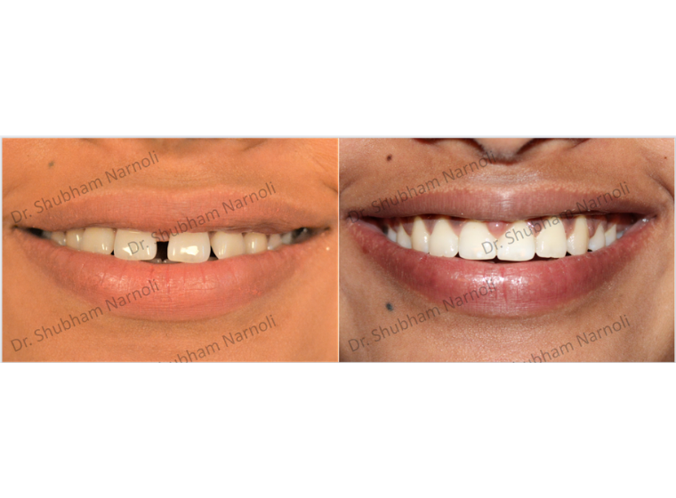 Smile makeover treatment at Doon Dental Square