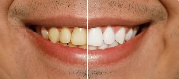 Professional teeth whitening session